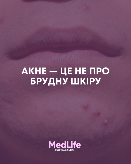 Акне — хронічне захворювання шкіри
